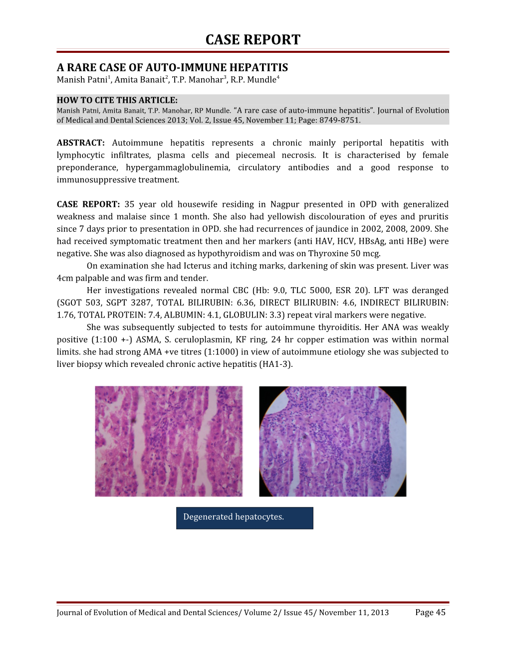 A Rare Case of Auto-Immune Hepatitis