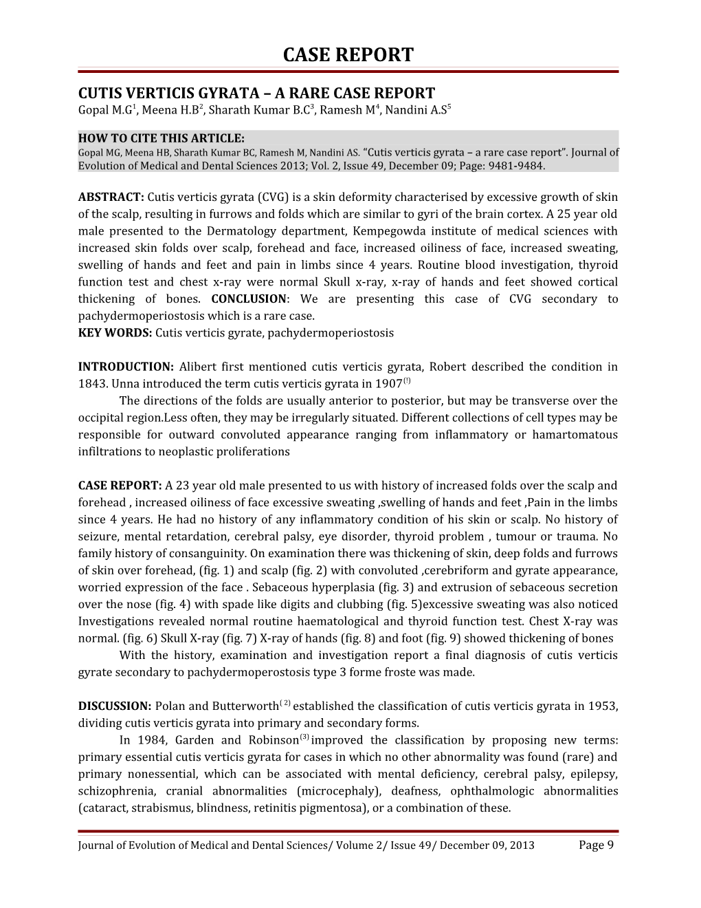 Cutis Verticis Gyrata a Rare Case Report