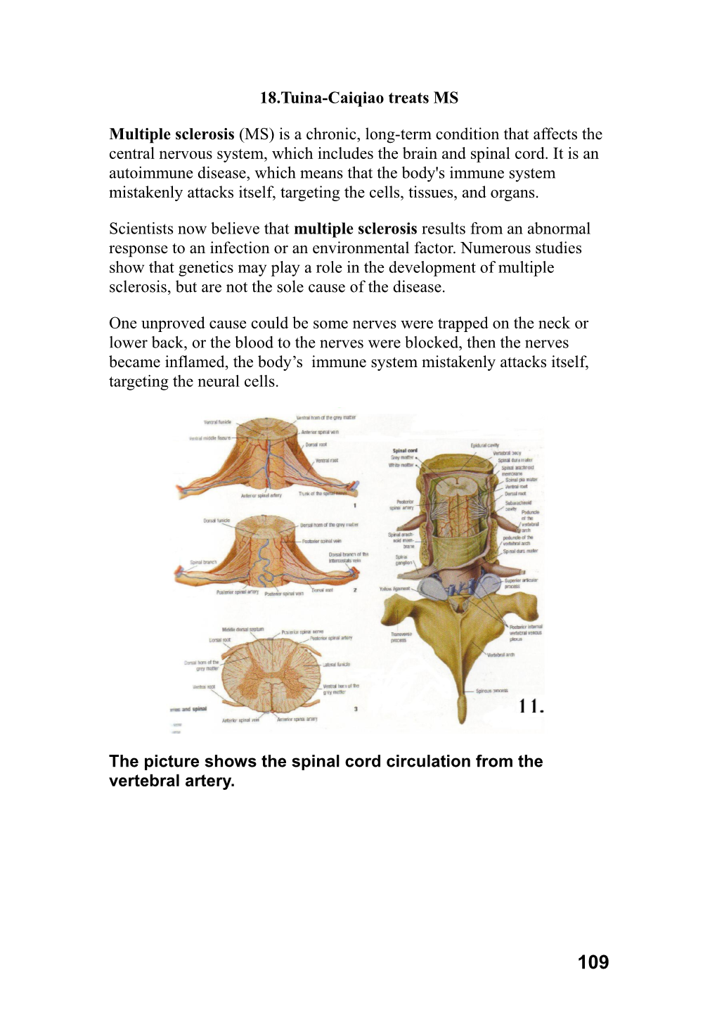 What Is Multiple Sclerosis