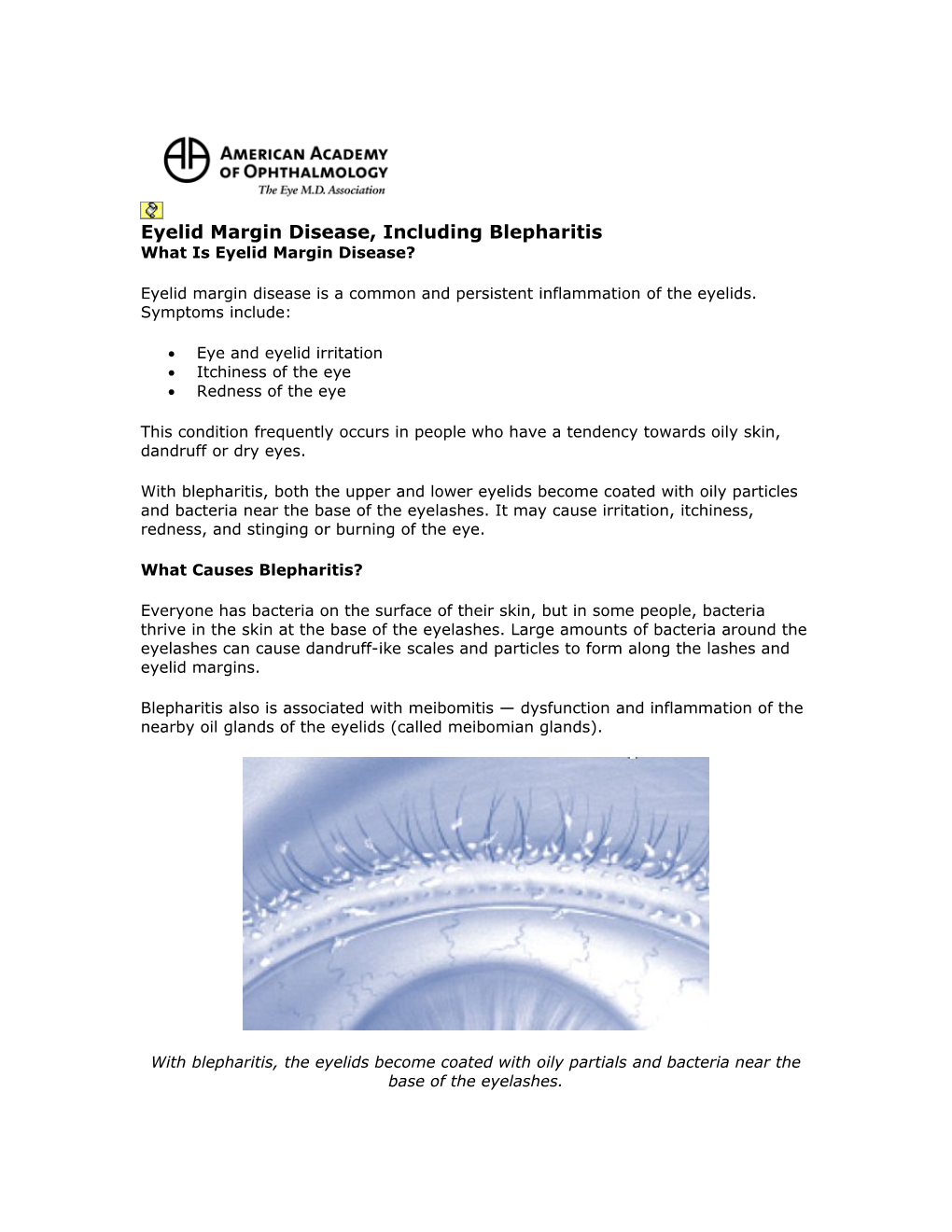 Eyelid Margin Disease, Including Blepharitis