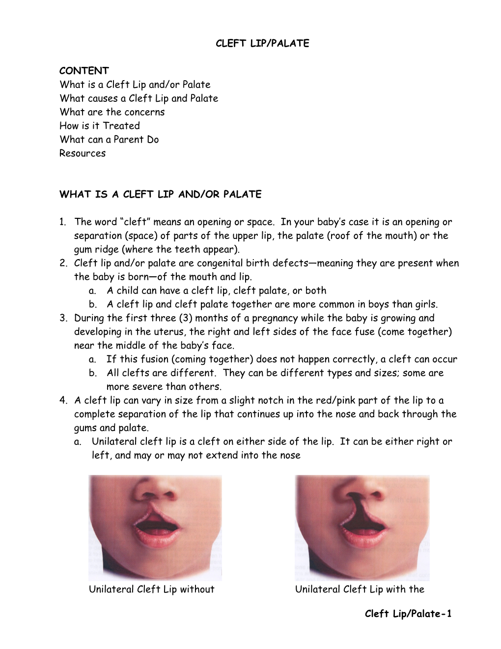 Cleft Lip/Palate