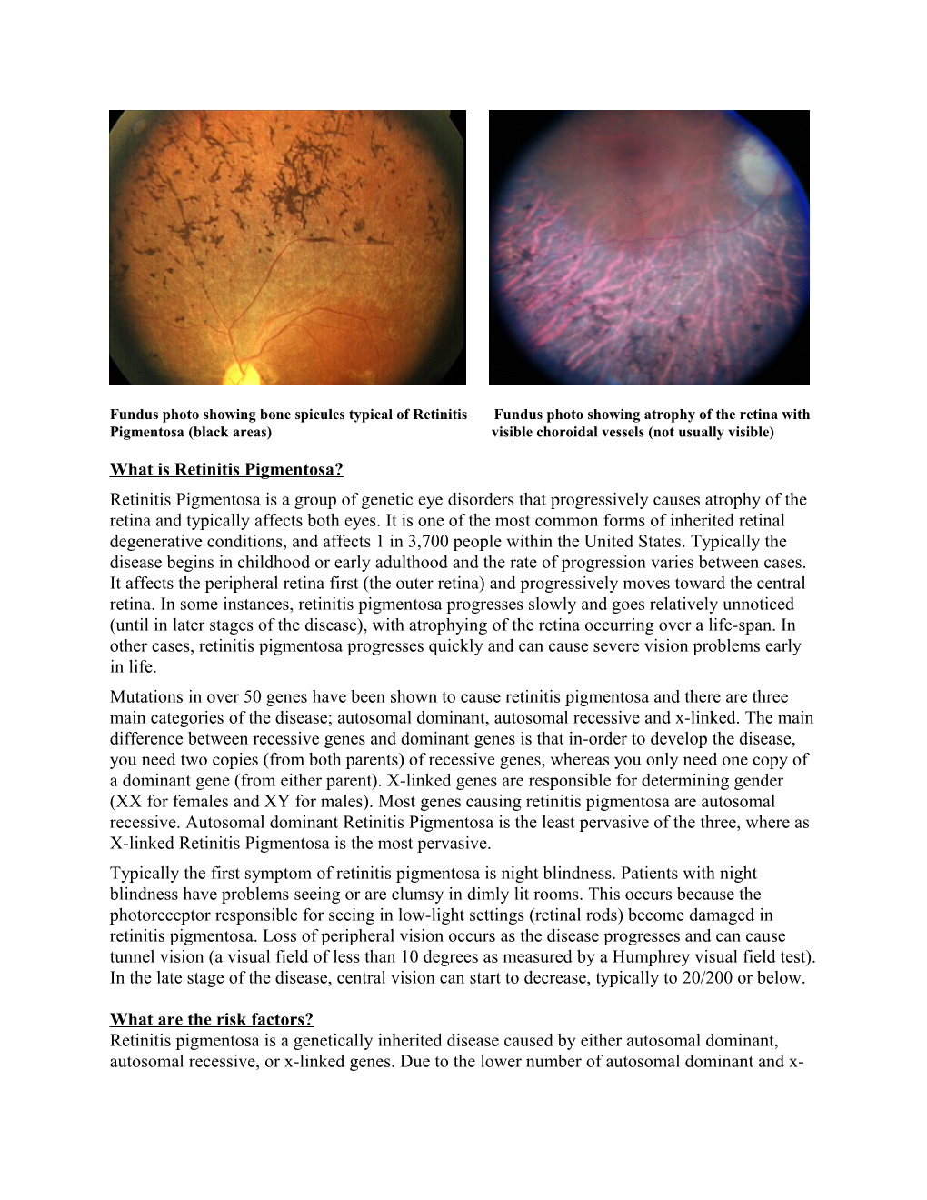 Pigmentosa(Black Areas) Visible Choroidal Vessels (Not Usually Visible)