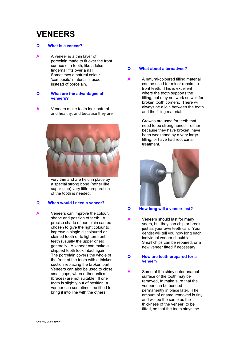 Qwhat Are the Advantages of Veneers?